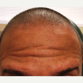 35-44 year old man treated with Dysport to the forehead before 2987999