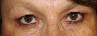 Upper Eyelid Surgery before 824343