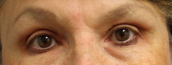 Upper Eyelid Surgery after 824343