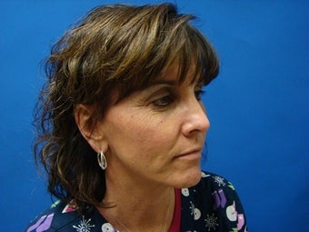 50-year-old patient treated for aging face before 1454013