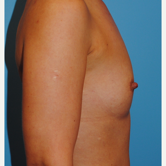 18-24 year old woman treated with Breast Augmentation before 3060822