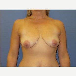 45-54 year old woman treated with Breast Lift with Implants before 1608366