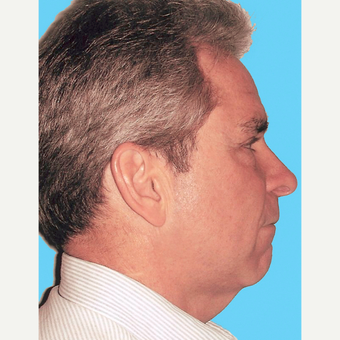 Neck Lift before 3824766