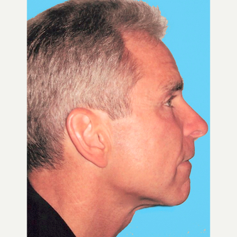 Neck Lift after 3824766