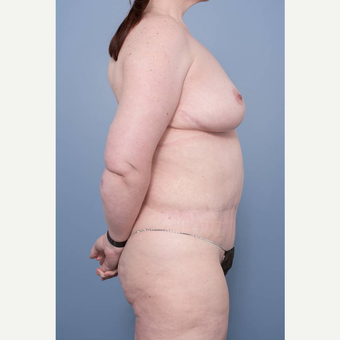 35-44 year old woman treated with Body Lift after 3455679