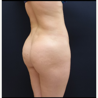 25-34 year old woman treated with Brazilian Butt Lift Revision with 712cc Round Silicone Implants before 3259485