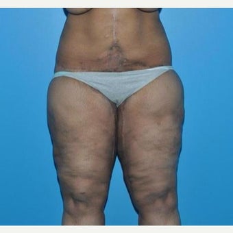 25-34 year old woman treated with Body Lift & Thigh Lift after 1866107
