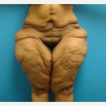 25-34 year old woman treated with Body Lift & Thigh Lift before 1866107