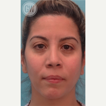 25-34 year old woman treated with Rhinoplasty before 3473392