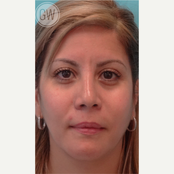 25-34 year old woman treated with Rhinoplasty after 3473392