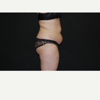 35-44 year old woman treated with Tummy Tuck before 3030851