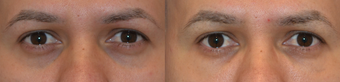 Treatment of Dark Circles Under the Eyes with Juvederm before 987766