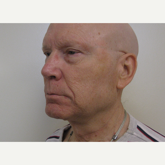 65-74 year old man treated with Neck Lift after 3439770