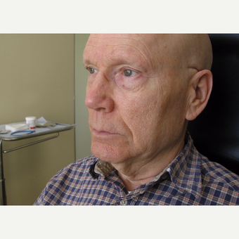 65-74 year old man treated with Neck Lift before 3439770