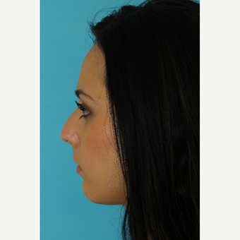 18-24 year old woman treated with Rhinoplasty before 3618391