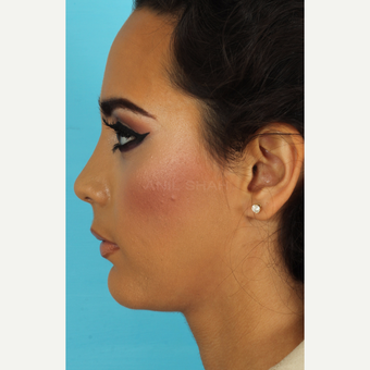 18-24 year old woman treated with Rhinoplasty after 3618391