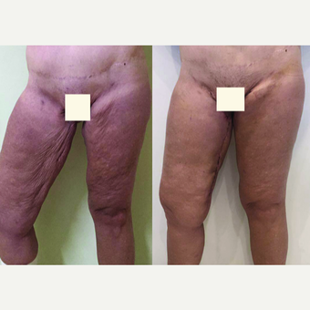 45-54 year old woman treated with Thigh Lift before 3442509