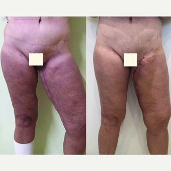 45-54 year old woman treated with Thigh Lift after 3442509