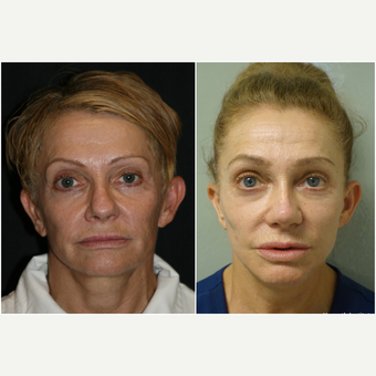 55-64 year old woman treated with Revision Rhinoplasty before 3847213