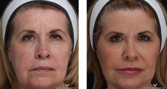 Liquid Facelift with Voluma & Juvederm before 1506637