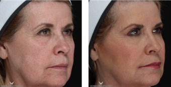 Liquid Facelift with Voluma & Juvederm 1506637