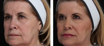 Liquid Facelift with Voluma & Juvederm after 1506637