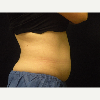 25-34 year old woman treated with CoolSculpting before 3679815