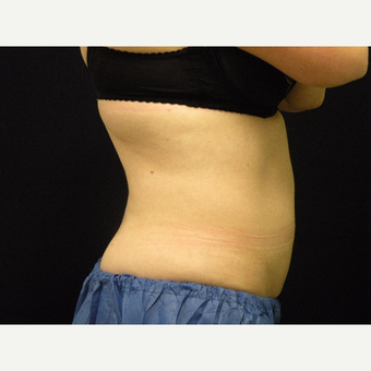 25-34 year old woman treated with CoolSculpting after 3679815