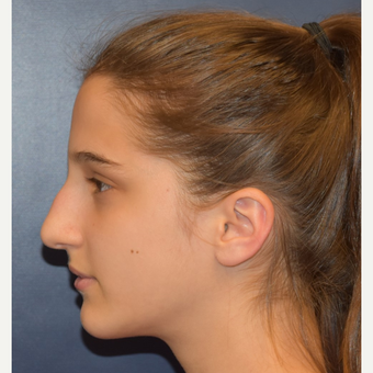 17 or under year old woman treated with Rhinoplasty before 3306012