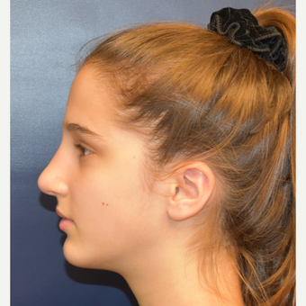 17 or under year old woman treated with Rhinoplasty after 3306012