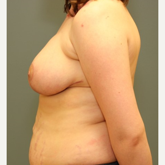 35-44 year old woman requesting a Breast Reduction after 3084447
