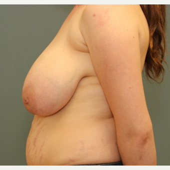 35-44 year old woman requesting a Breast Reduction before 3084447