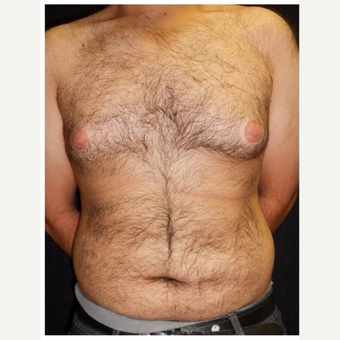 25-34 year old man treated with Male Breast Reduction before 3185995