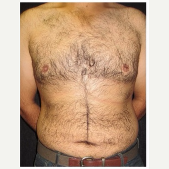 25-34 year old man treated with Male Breast Reduction after 3185995