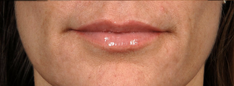 Restylane Lips after 417891
