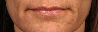 Restylane Lips before 417891