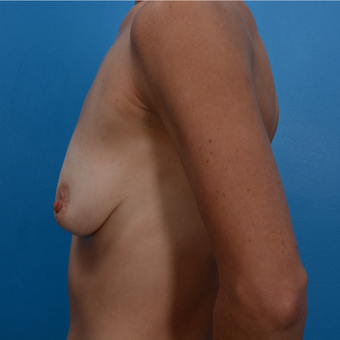 38 year old woman treated with Breast Lift with Implants before 3327131