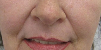 54 year old Female Treatment for Naso-labial fold before 694144