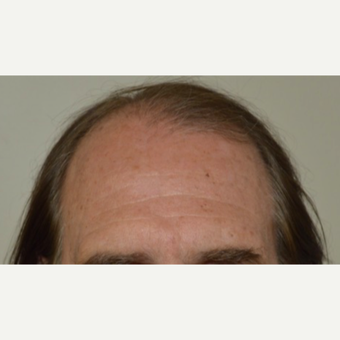 55-64 year old man treated with FUE Hair Transplant before 3750175
