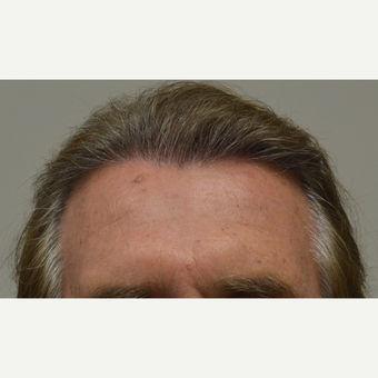 55-64 year old man treated with FUE Hair Transplant after 3750175