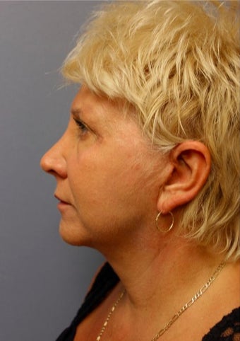 65-74 year old woman treated with Facelift after 3476181