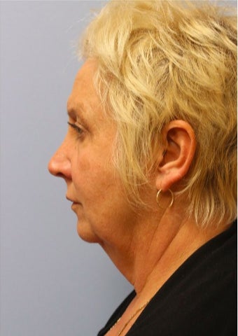65-74 year old woman treated with Facelift before 3476181