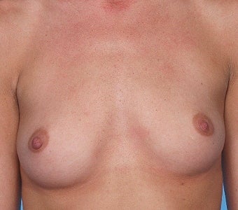 Breast augmentation with Silicone Implants before 67253