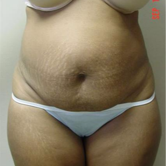 35-44 year old woman treated with Tummy Tuck before 3287711