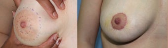 28 years female underwent Aureola reduction that resulted also into some breast lift before 932044