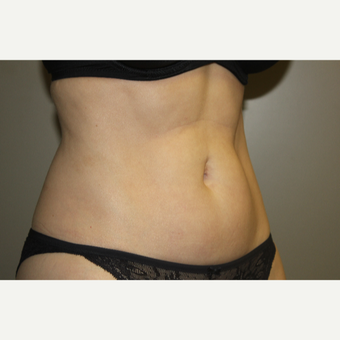 45-54 year old woman treated with SculpSure after 3706740