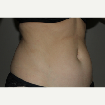 45-54 year old woman treated with SculpSure before 3706740