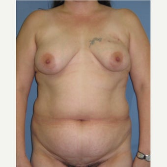 35-44 year old woman treated with Breast Reconstruction before 1835952
