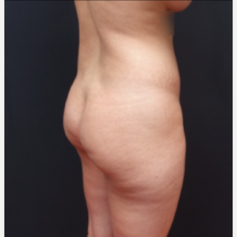 25-34 year old woman treated with Fat Transfer before 3267084