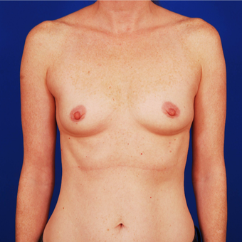 25-34 year old woman treated with Breast Augmentation before 3742356